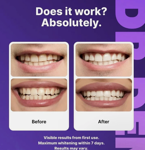 Teeth Whitening Strips